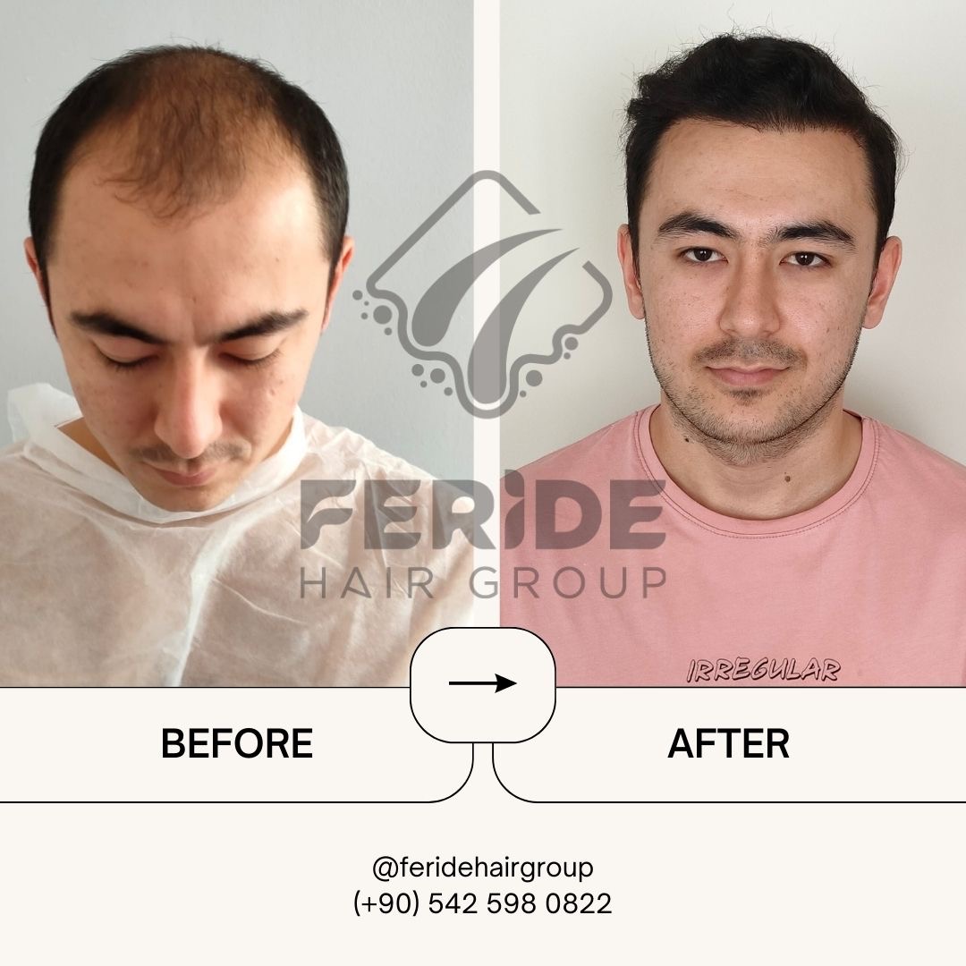 trapianto di capelli