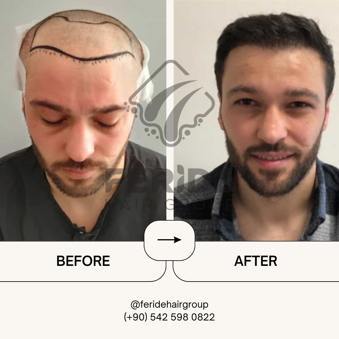 trapianto di capelli