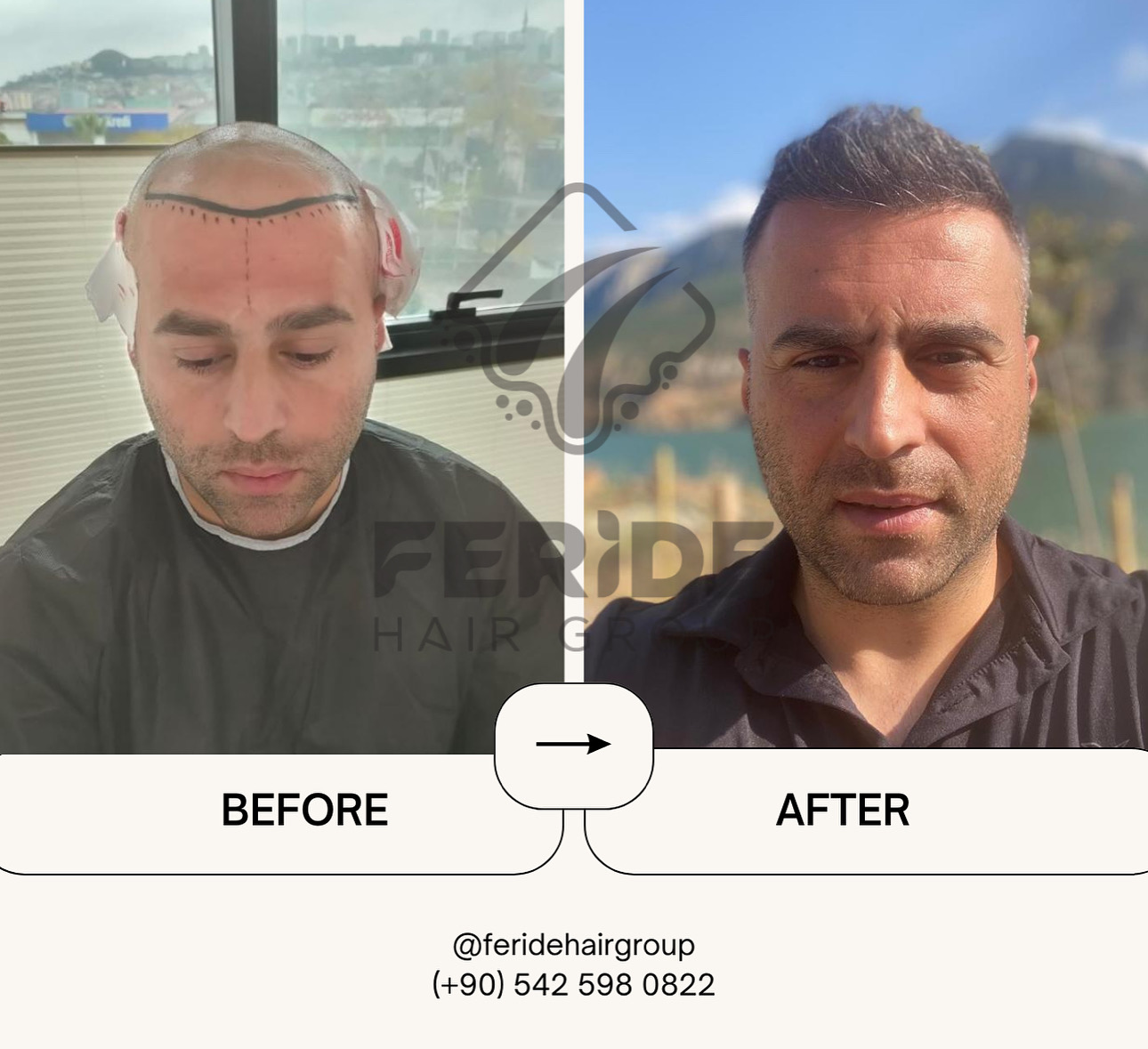 trapianto di capelli