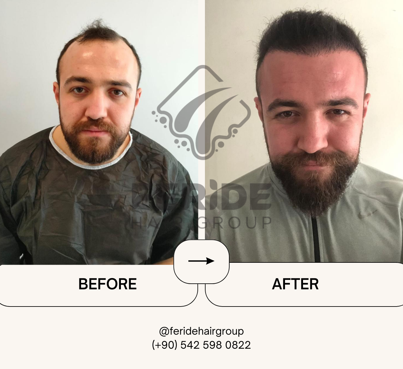 trapianto di capelli