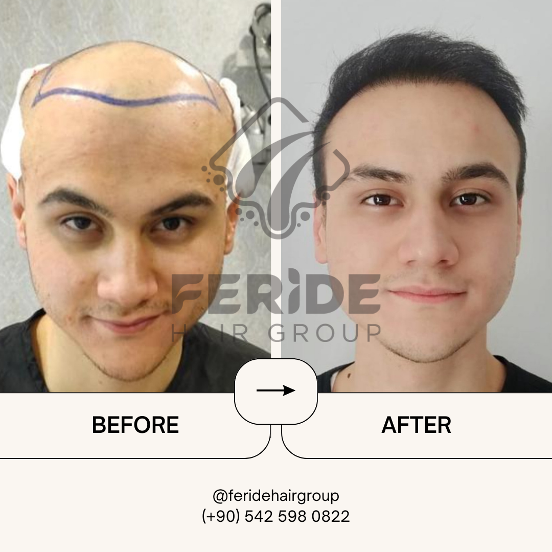 trapianto di capelli