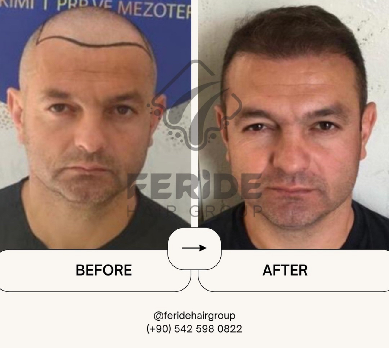 trapianto di capelli