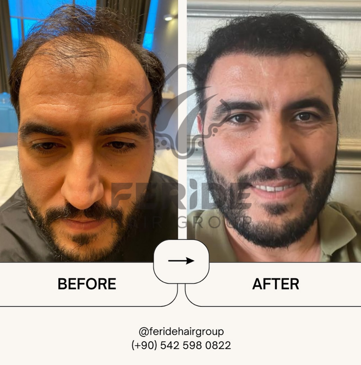 trapianto di capelli