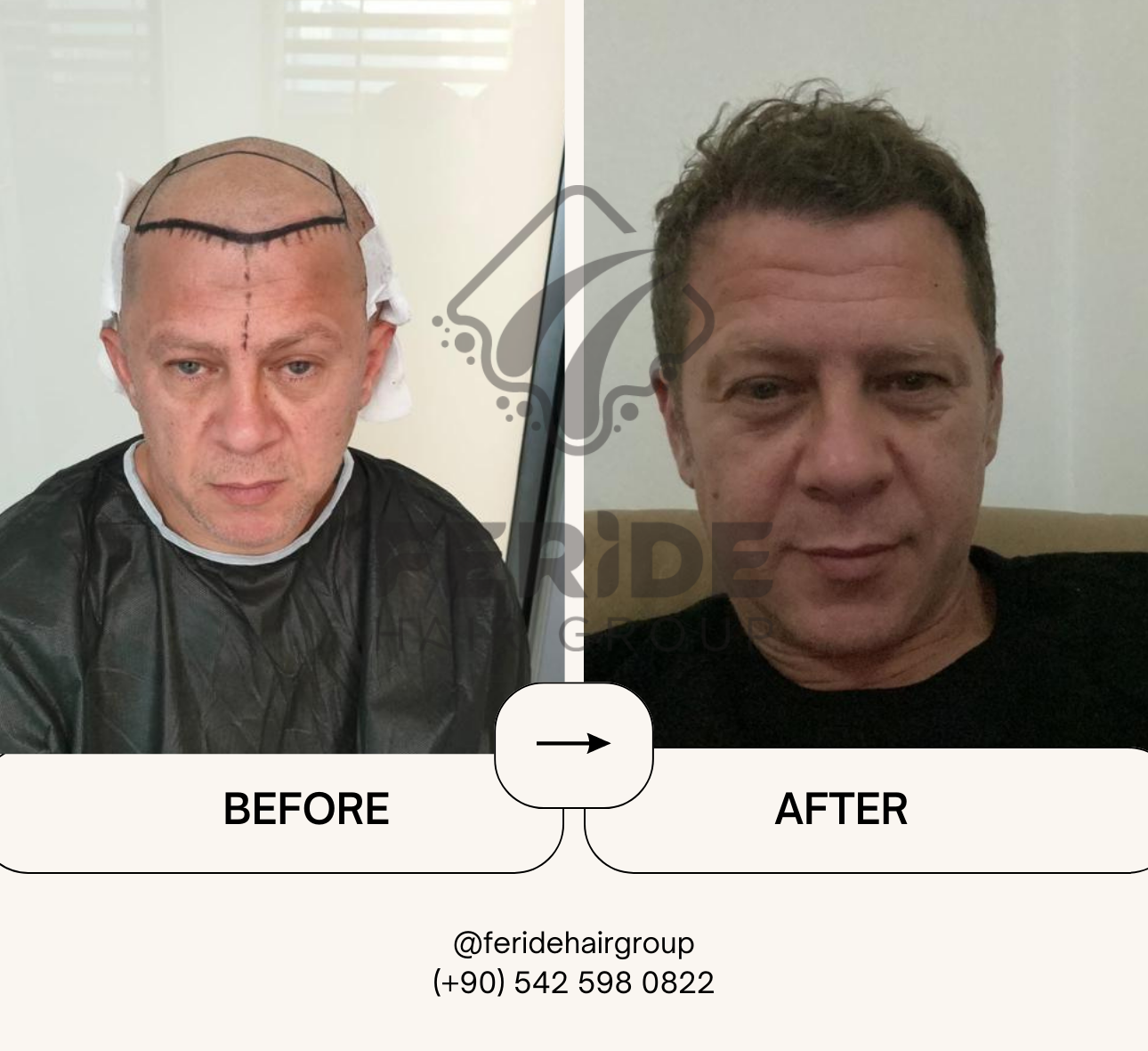 trapianto di capelli