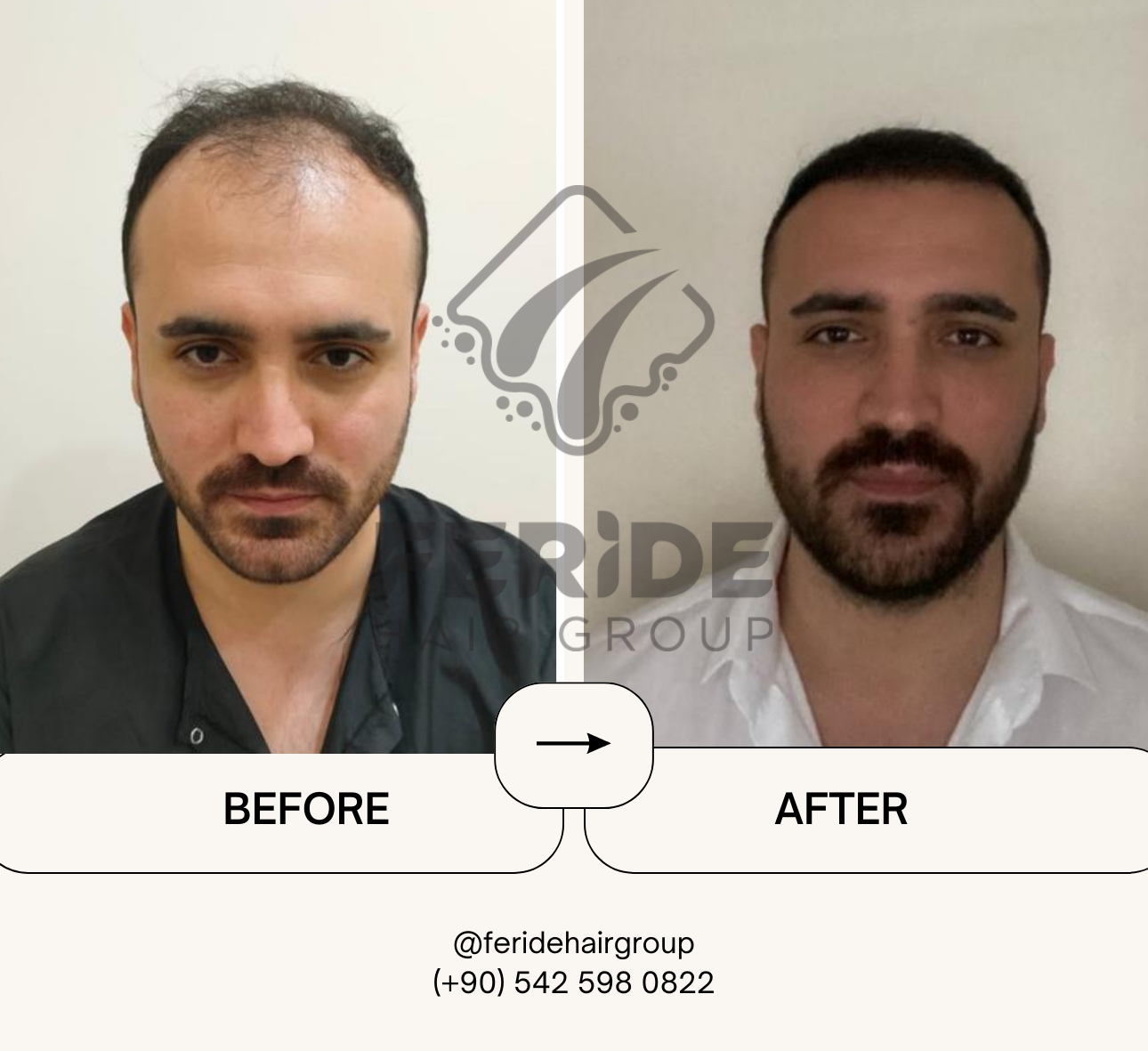 trapianto di capelli