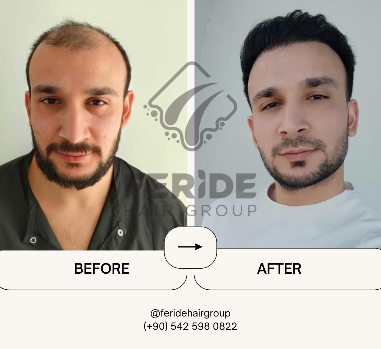 trapianto di capelli