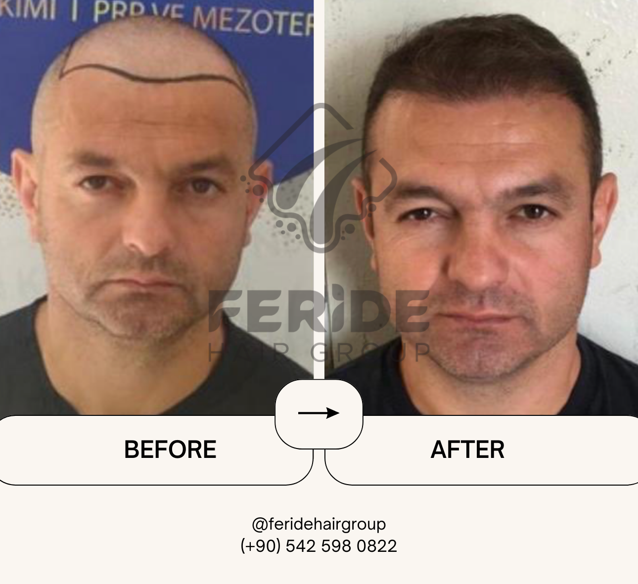 trapianto di capelli