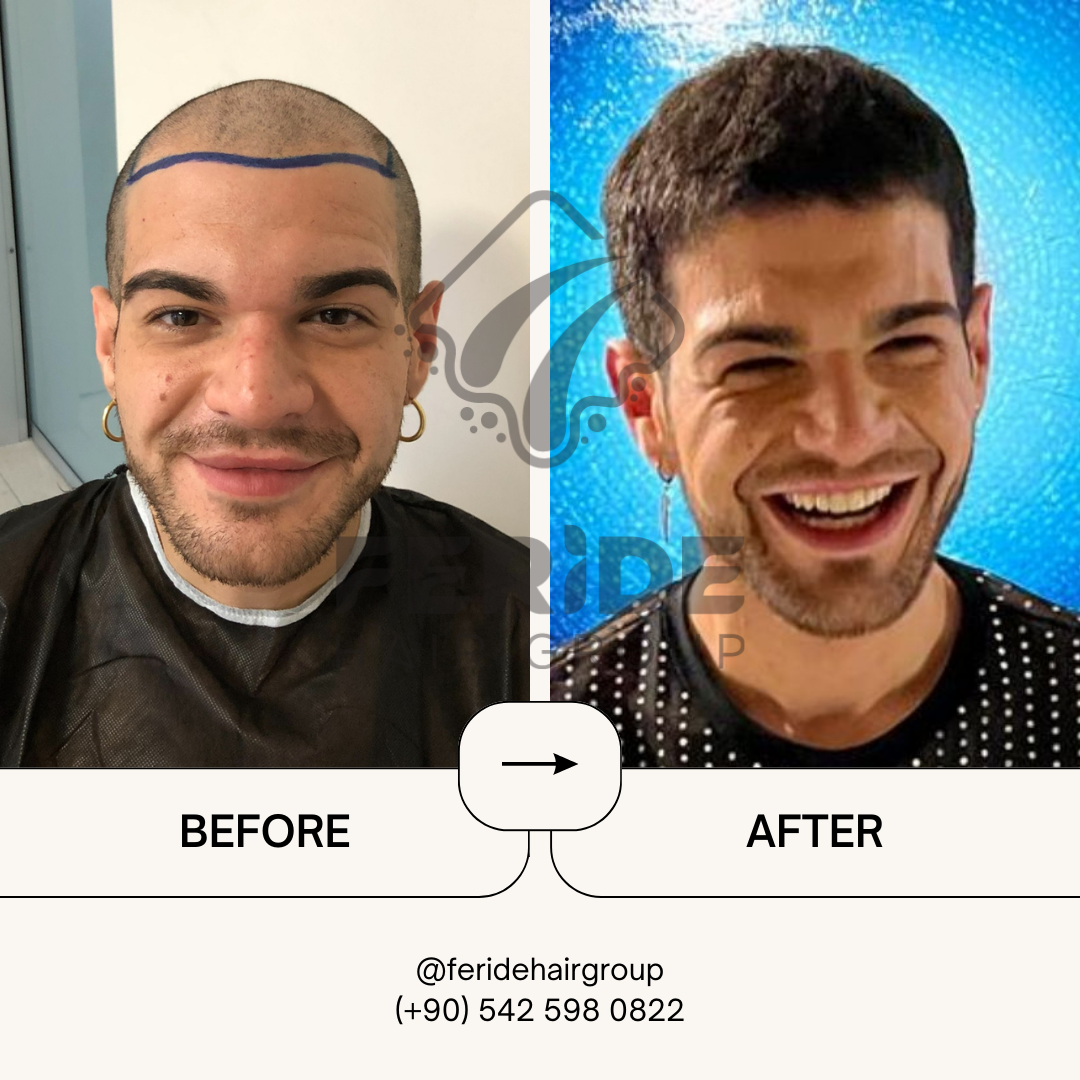 trapianto di capelli