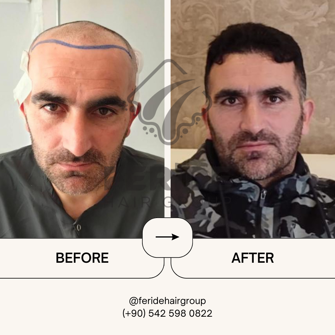 trapianto di capelli