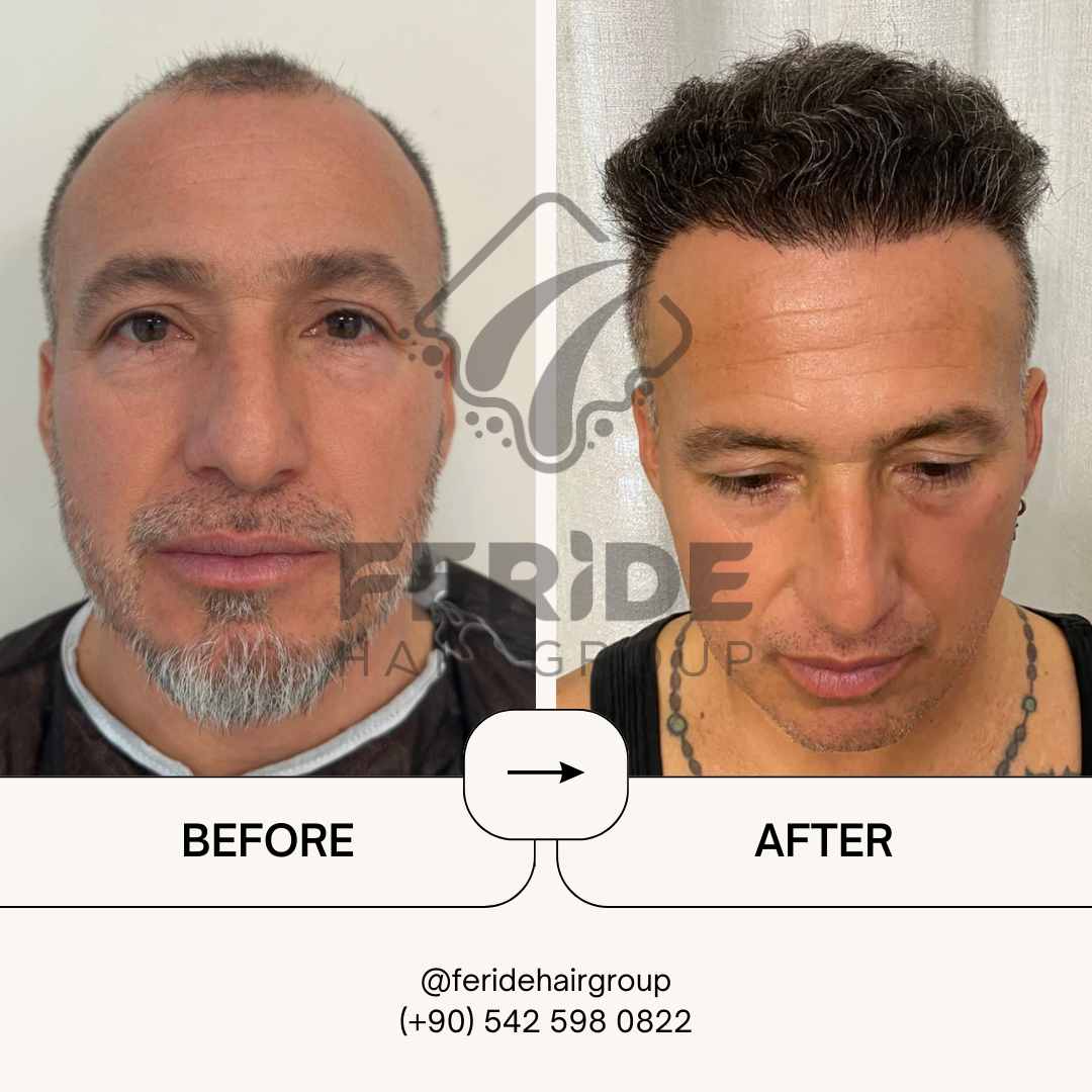 trapianto di capelli